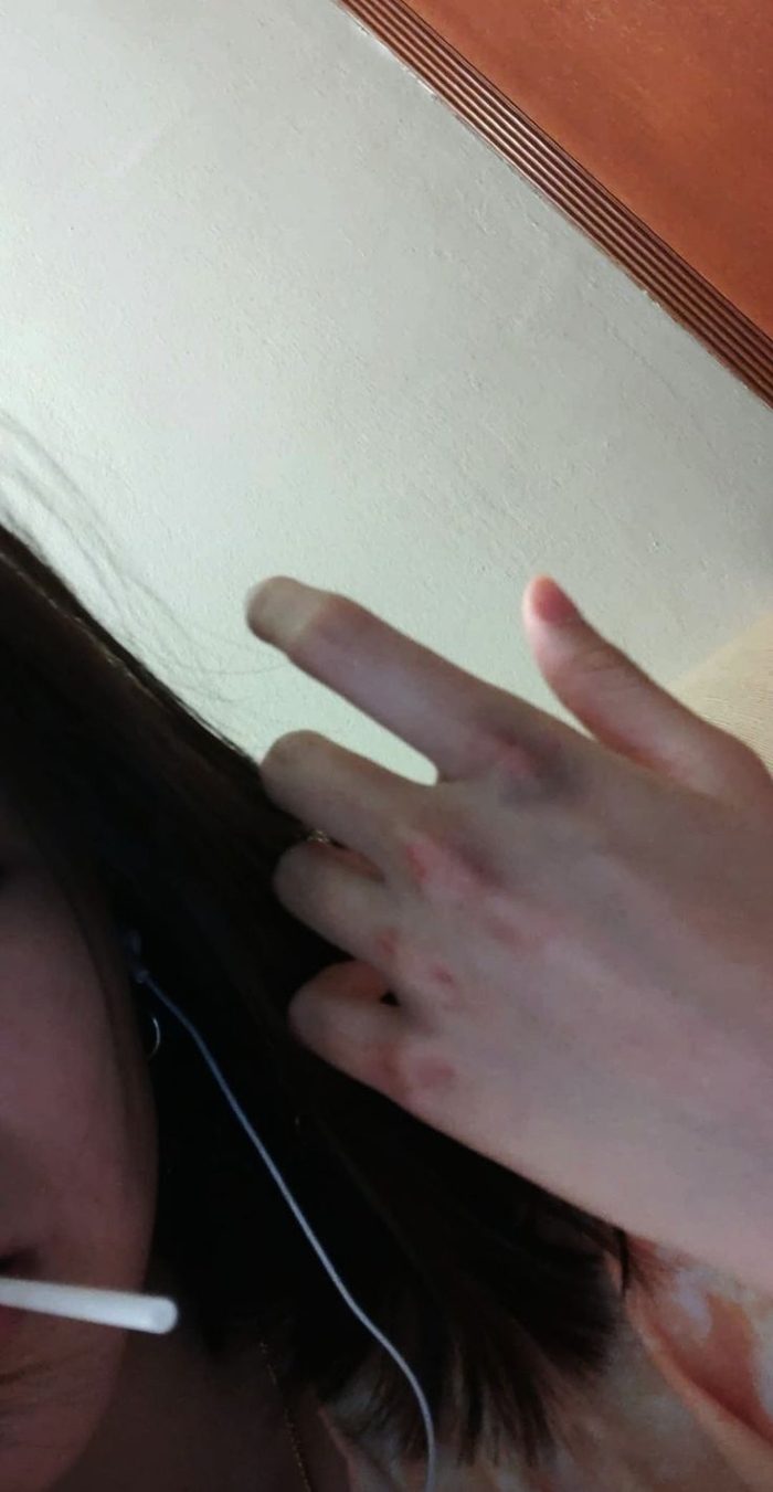 ảnh xước tay ngã xe