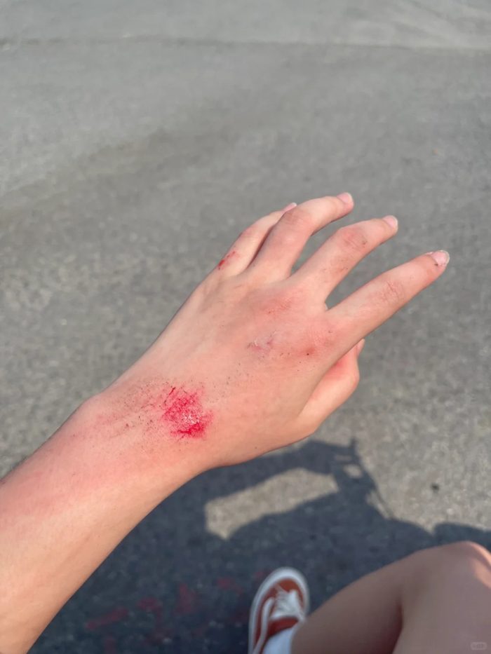 ảnh ngã xe xước tay