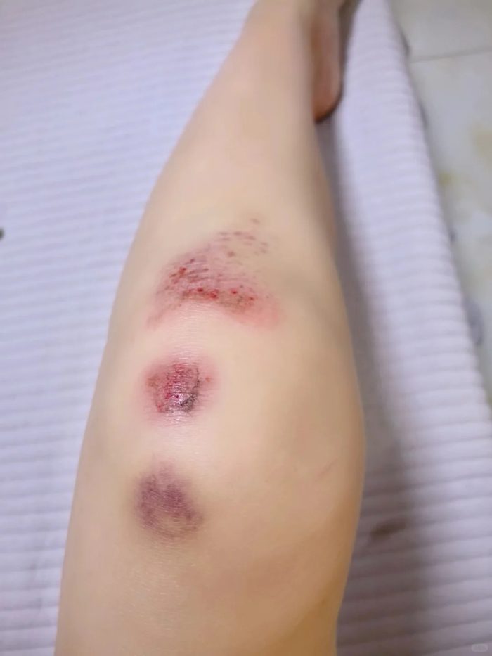 ảnh ngã xe xước chân