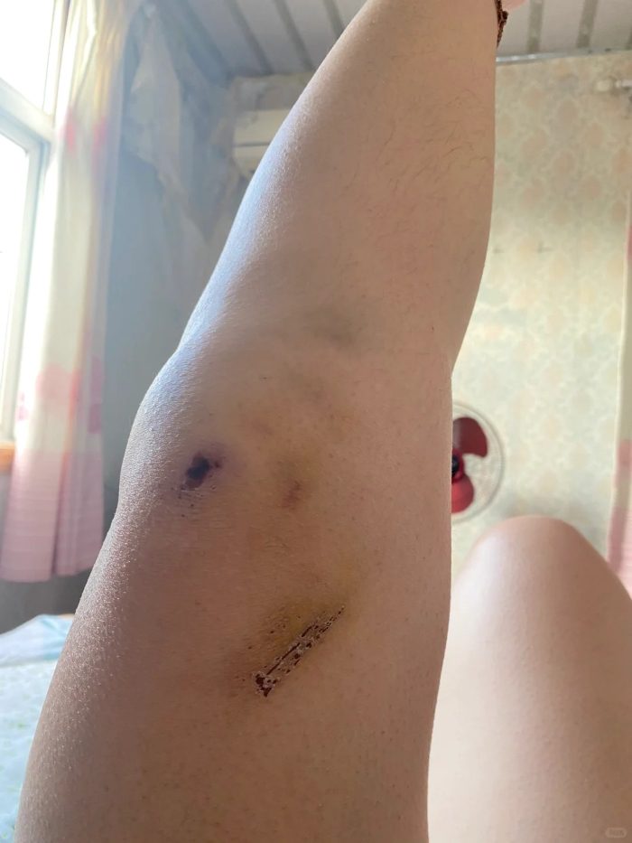 ảnh ngã xe xước chân 1