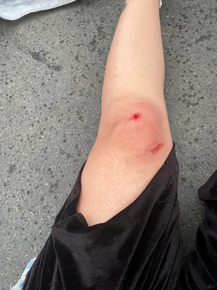 ảnh ngã xe xước chân 32