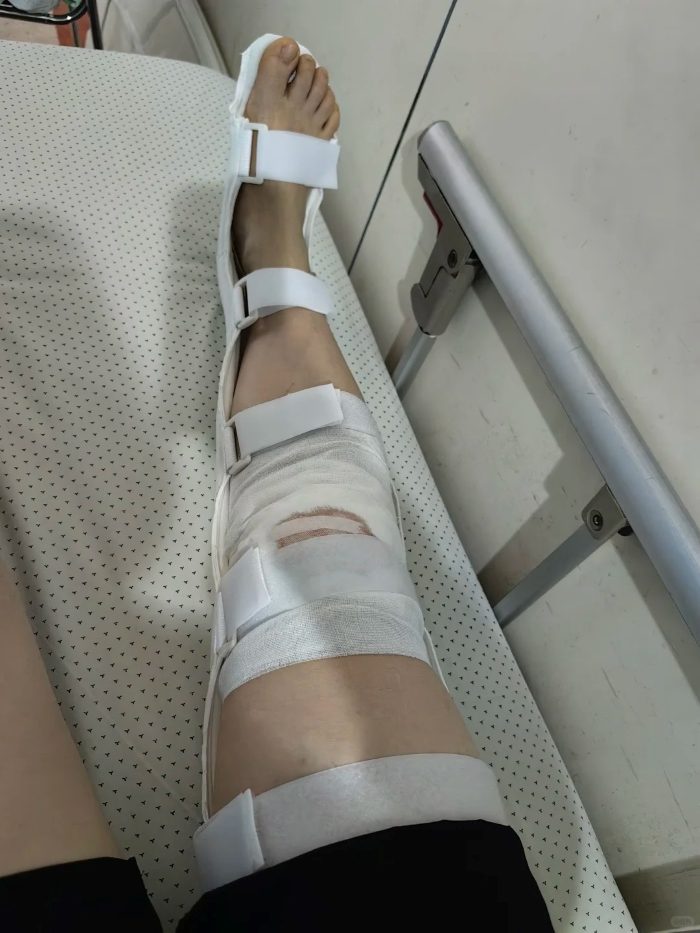 ảnh ngã xe xước chân 33