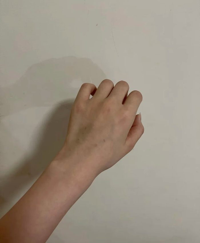 ảnh truyền nước ở tay nữ 31