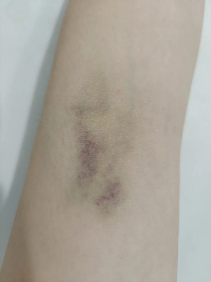 ảnh truyền nước ở tay nữ 32